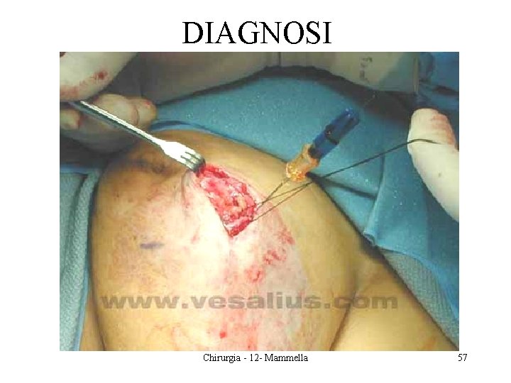 DIAGNOSI Chirurgia - 12 - Mammella 57 
