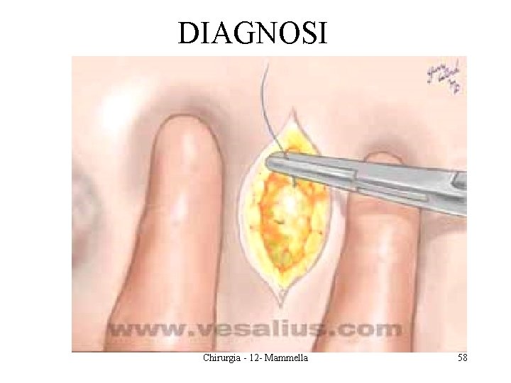 DIAGNOSI Chirurgia - 12 - Mammella 58 