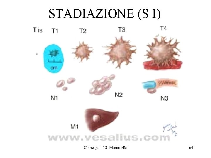 STADIAZIONE (S I) Chirurgia - 12 - Mammella 64 STADIAZIONE (S I) Chirurgia - 12 - Mammella 64