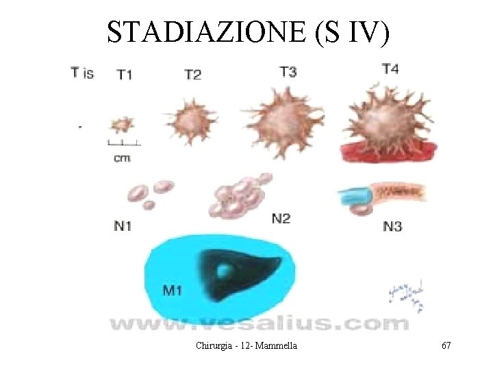 STADIAZIONE (S IV) Chirurgia - 12 - Mammella 67 