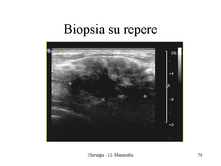 Biopsia su repere Chirurgia - 12 - Mammella 76 