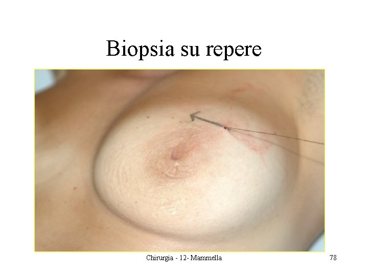 Biopsia su repere Chirurgia - 12 - Mammella 78 