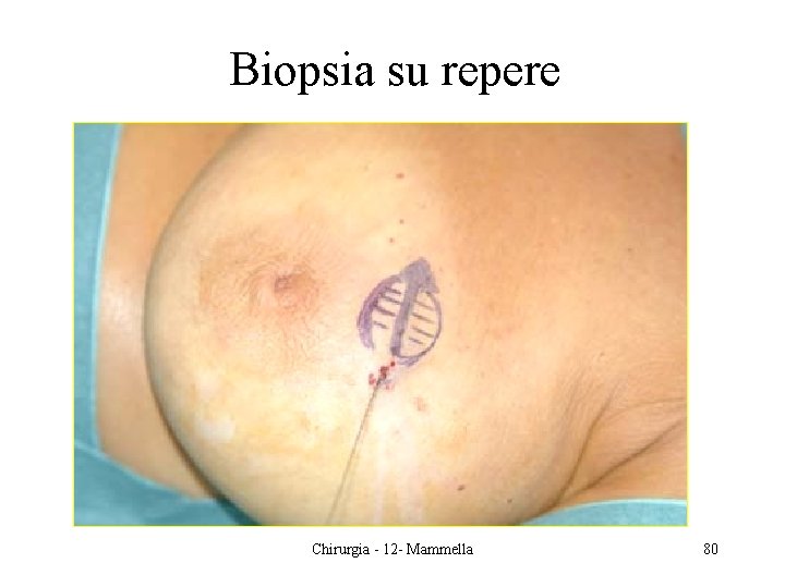 Biopsia su repere Chirurgia - 12 - Mammella 80 