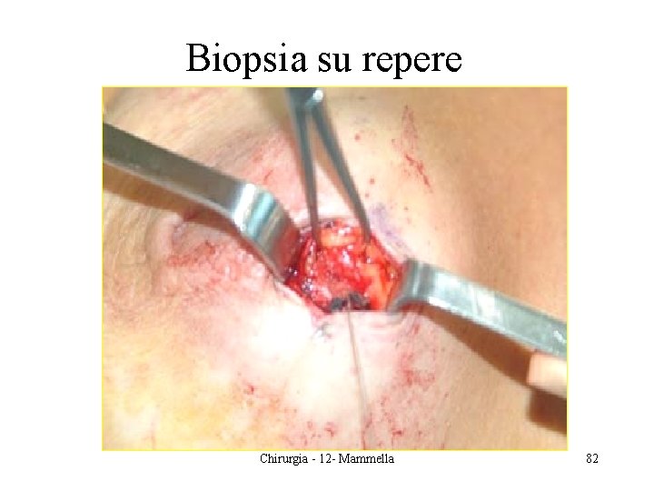 Biopsia su repere Chirurgia - 12 - Mammella 82 