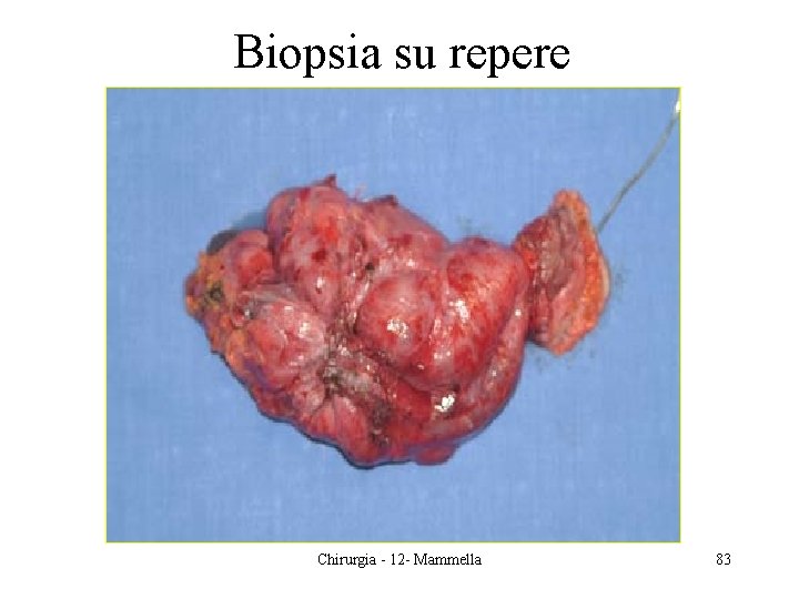 Biopsia su repere Chirurgia - 12 - Mammella 83 