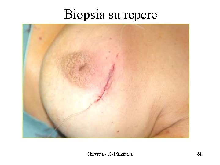 Biopsia su repere Chirurgia - 12 - Mammella 84 