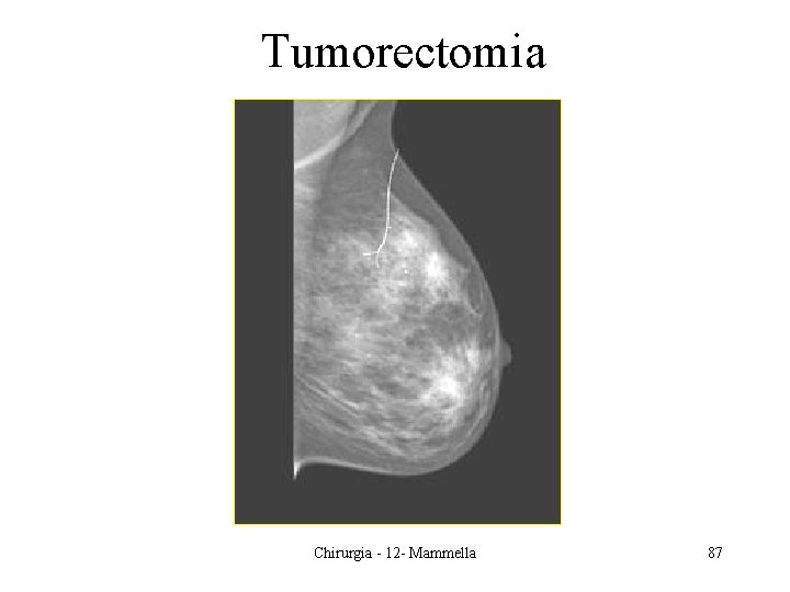 Tumorectomia Chirurgia - 12 - Mammella 87 