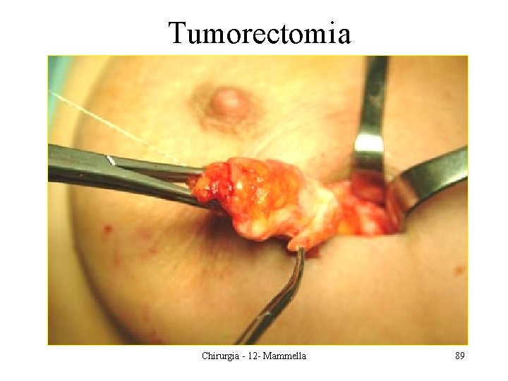 Tumorectomia Chirurgia - 12 - Mammella 89 