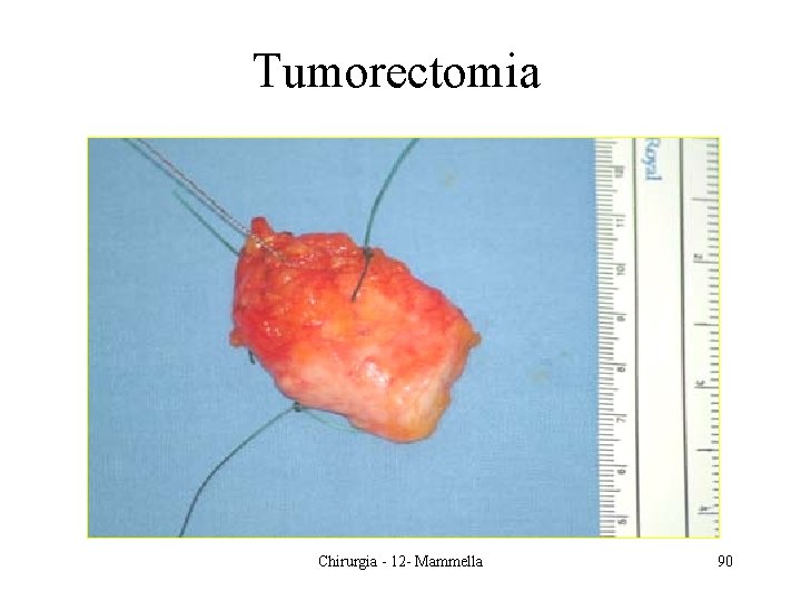 Tumorectomia Chirurgia - 12 - Mammella 90 