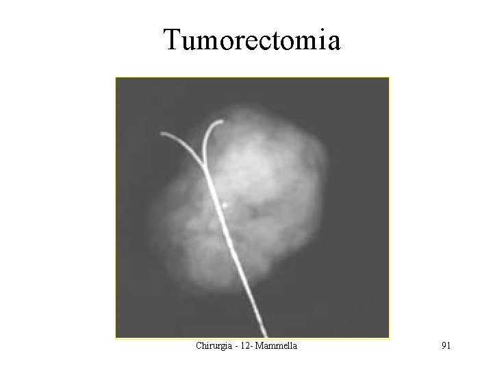 Tumorectomia Chirurgia - 12 - Mammella 91 