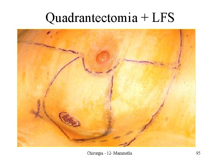 Quadrantectomia + LFS Chirurgia - 12 - Mammella 95 