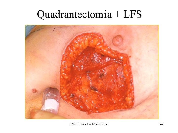 Quadrantectomia + LFS Chirurgia - 12 - Mammella 96 Quadrantectomia + LFS Chirurgia - 12 - Mammella 96
