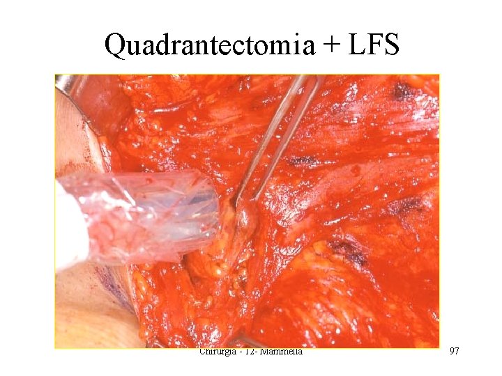 Quadrantectomia + LFS Chirurgia - 12 - Mammella 97 