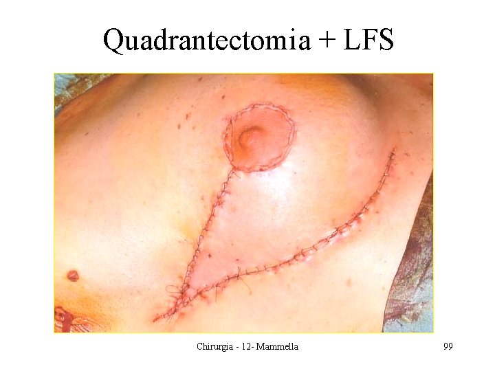 Quadrantectomia + LFS Chirurgia - 12 - Mammella 99 