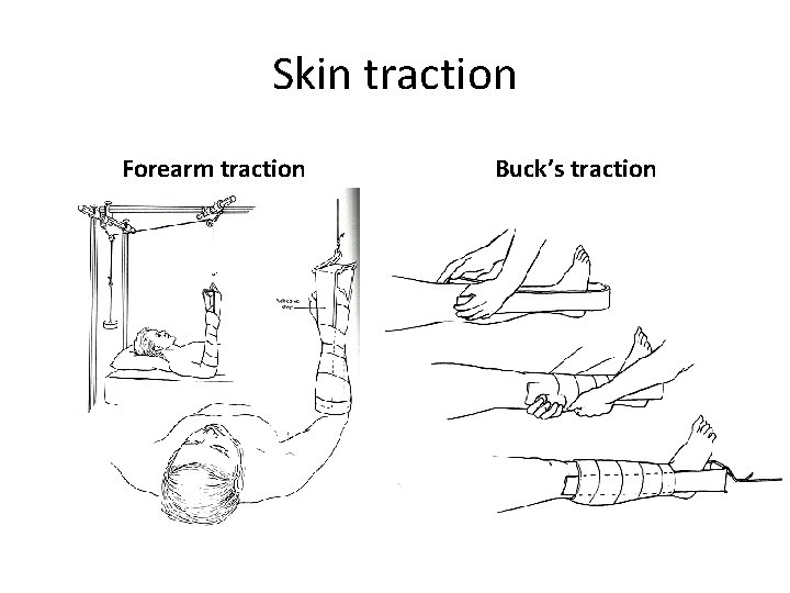 Skin traction Forearm traction Buck’s traction 