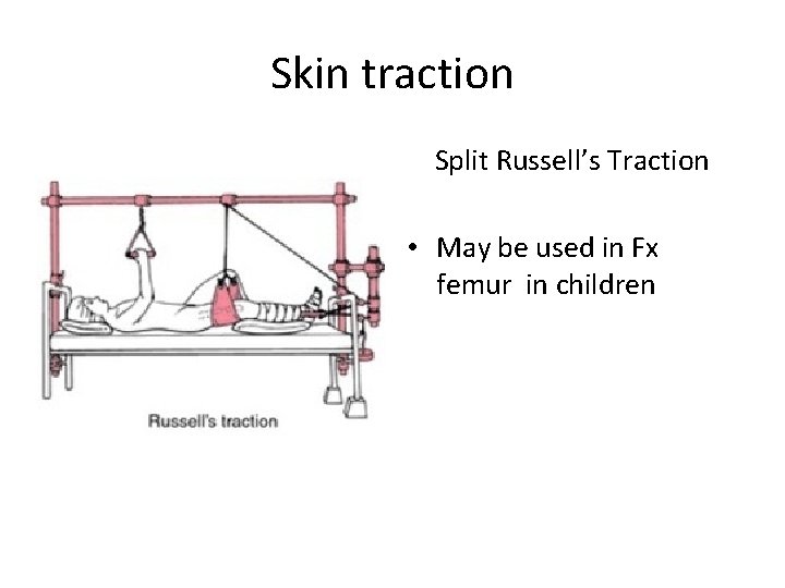 Skin traction Split Russell’s Traction • May be used in Fx femur in children