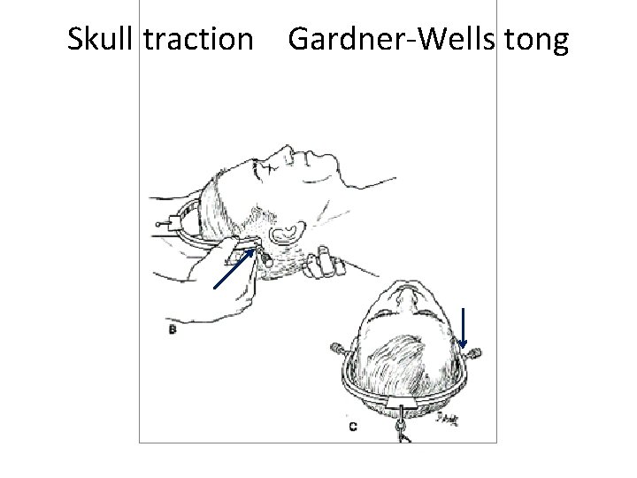 Skull traction Gardner-Wells tong 