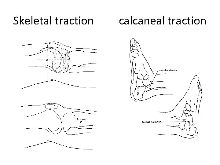 Skeletal traction calcaneal traction 