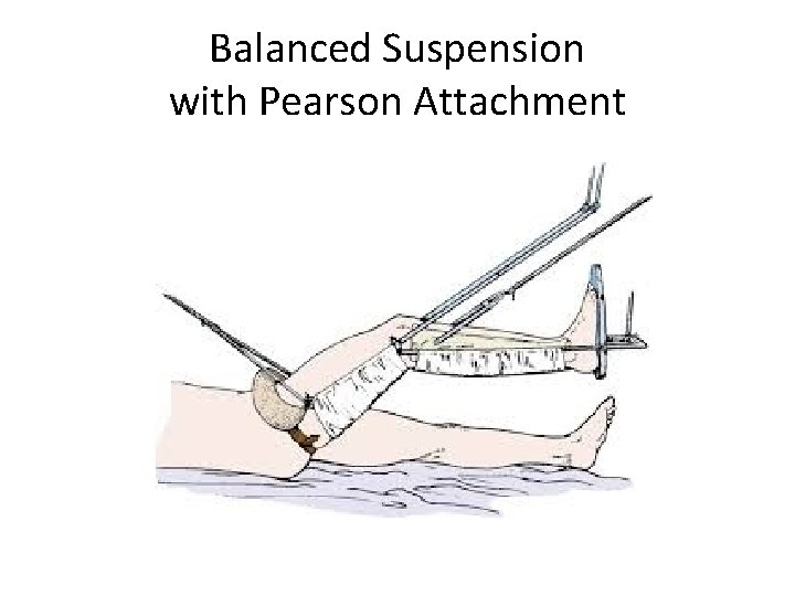 Balanced Suspension with Pearson Attachment 