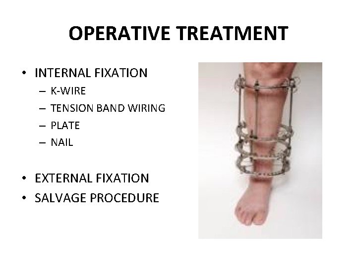 OPERATIVE TREATMENT • INTERNAL FIXATION – – K-WIRE TENSION BAND WIRING PLATE NAIL •