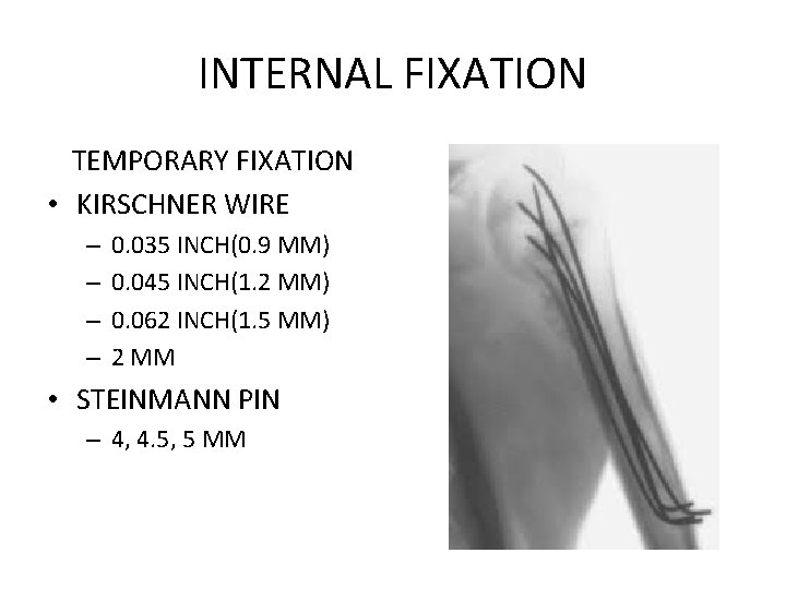 INTERNAL FIXATION TEMPORARY FIXATION • KIRSCHNER WIRE – – 0. 035 INCH(0. 9 MM)