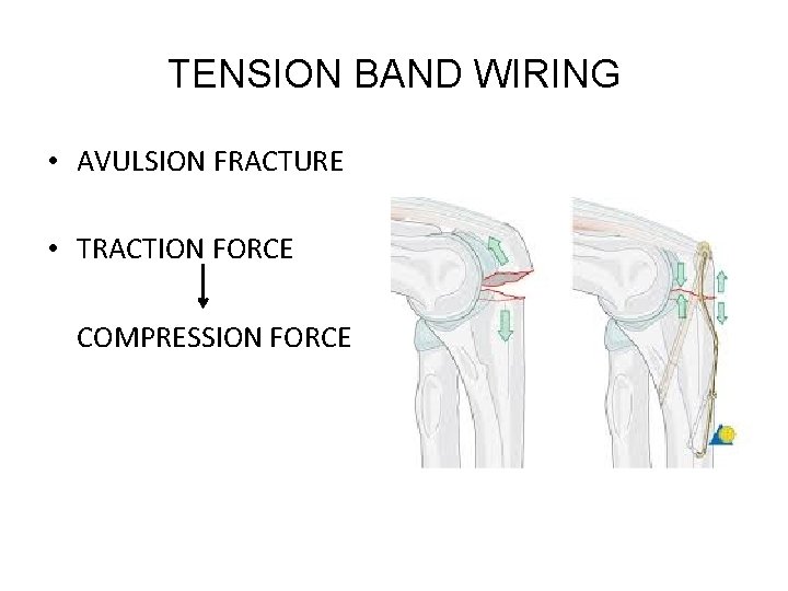 TENSION BAND WIRING • AVULSION FRACTURE • TRACTION FORCE COMPRESSION FORCE 