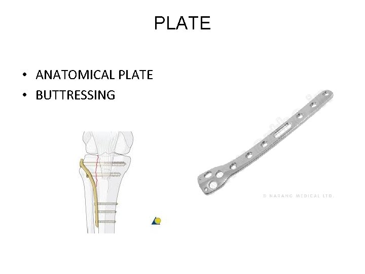 PLATE • ANATOMICAL PLATE • BUTTRESSING 