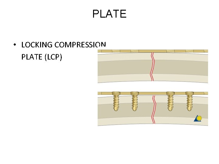 PLATE • LOCKING COMPRESSION PLATE (LCP) 