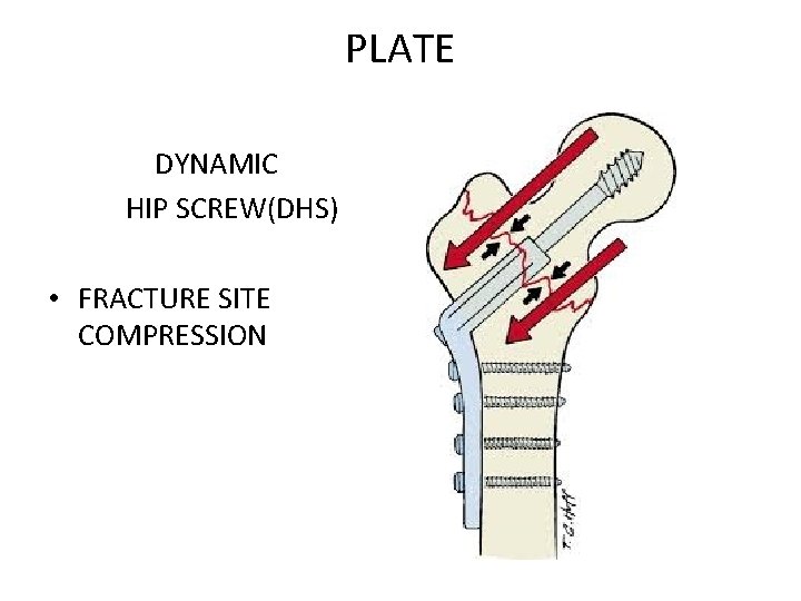 PLATE DYNAMIC HIP SCREW(DHS) • FRACTURE SITE COMPRESSION 