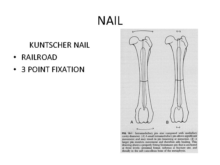 NAIL KUNTSCHER NAIL • RAILROAD • 3 POINT FIXATION 