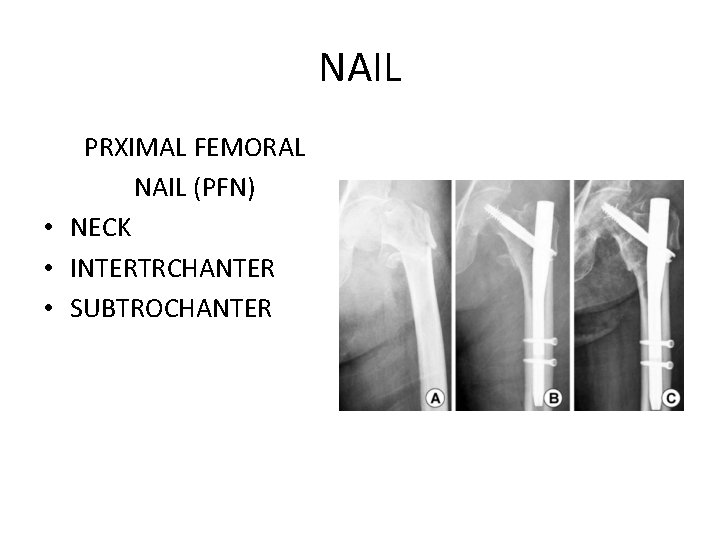 NAIL PRXIMAL FEMORAL NAIL (PFN) • NECK • INTERTRCHANTER • SUBTROCHANTER 