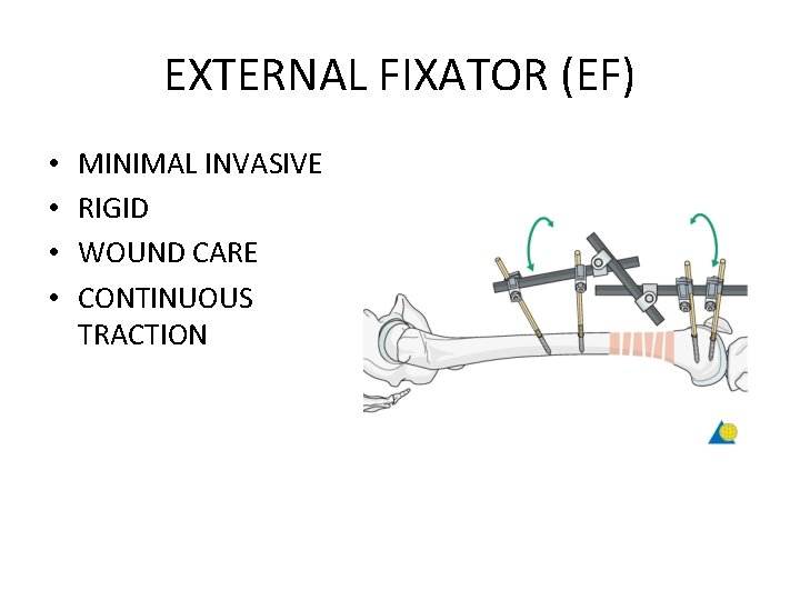 EXTERNAL FIXATOR (EF) • • MINIMAL INVASIVE RIGID WOUND CARE CONTINUOUS TRACTION 