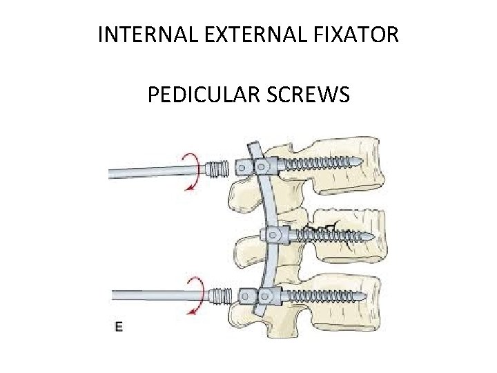 INTERNAL EXTERNAL FIXATOR PEDICULAR SCREWS 