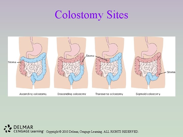 Colostomy Sites Copyright © 2010 Delmar, Cengage Learning. ALL RIGHTS RESERVED. 