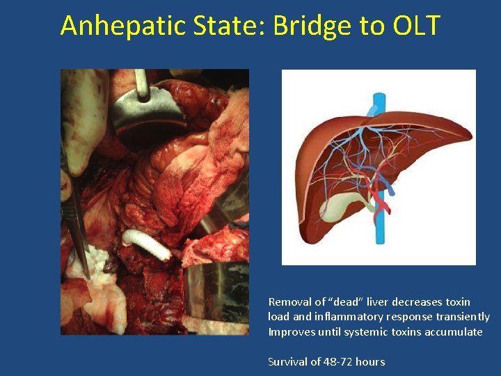 Anhepatic State: Bridge to OLT Removal of “dead” liver decreases toxin load and inflammatory