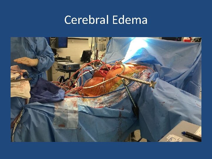 Cerebral Edema 