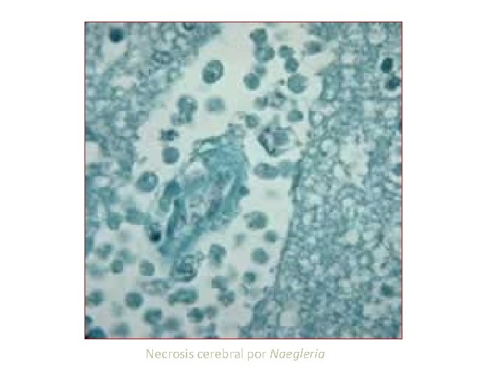 Necrosis cerebral por Naegleria 
