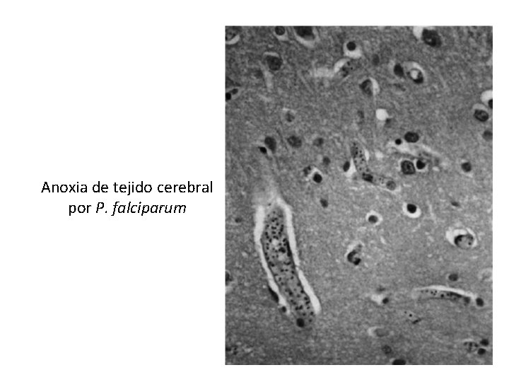 Anoxia de tejido cerebral por P. falciparum 