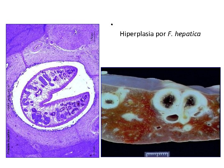 . Hiperplasia por F. hepatica 