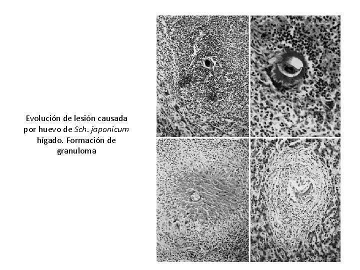 Evolución de lesión causada por huevo de Sch. japonicum hígado. Formación de granuloma 
