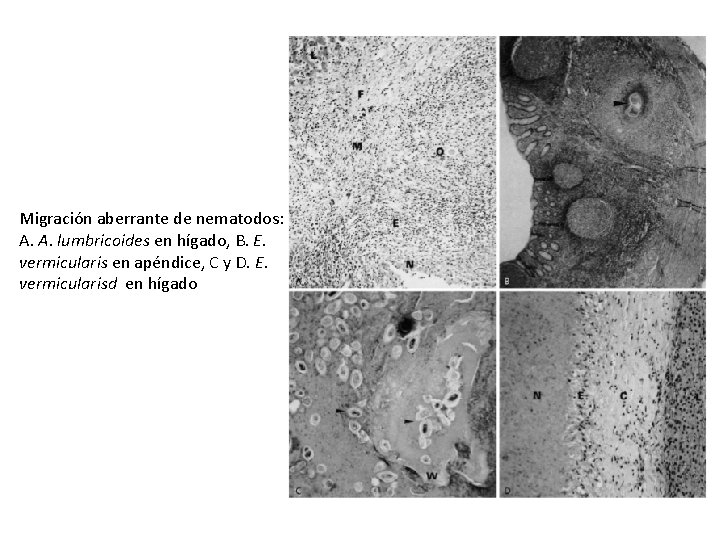 Migración aberrante de nematodos: A. A. lumbricoides en hígado, B. E. vermicularis en apéndice,