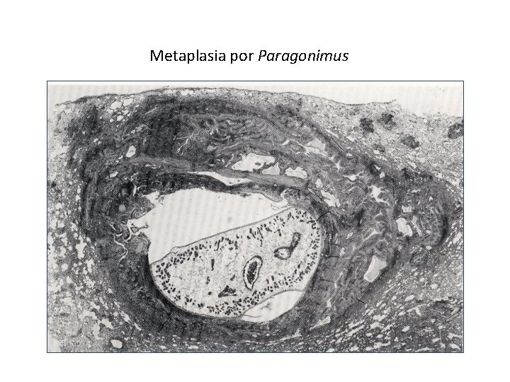 Metaplasia por Paragonimus 