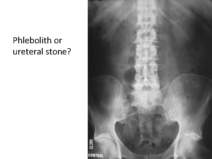 Renal Colic M Gharaati M D Urologist Fellowship