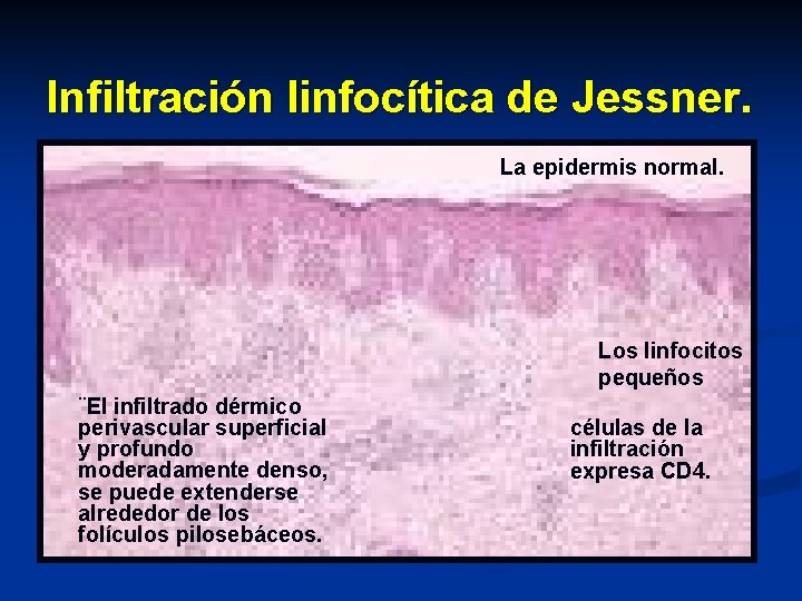 Infiltración linfocítica de Jessner. La epidermis normal. Los linfocitos pequeños ¨El infiltrado dérmico perivascular