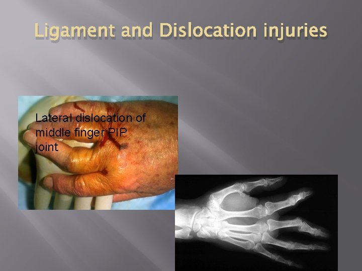 Ligament and Dislocation injuries Lateral dislocation of middle finger PIP joint. 