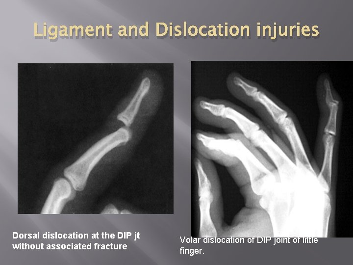 Ligament and Dislocation injuries Dorsal dislocation at the DIP jt without associated fracture Volar