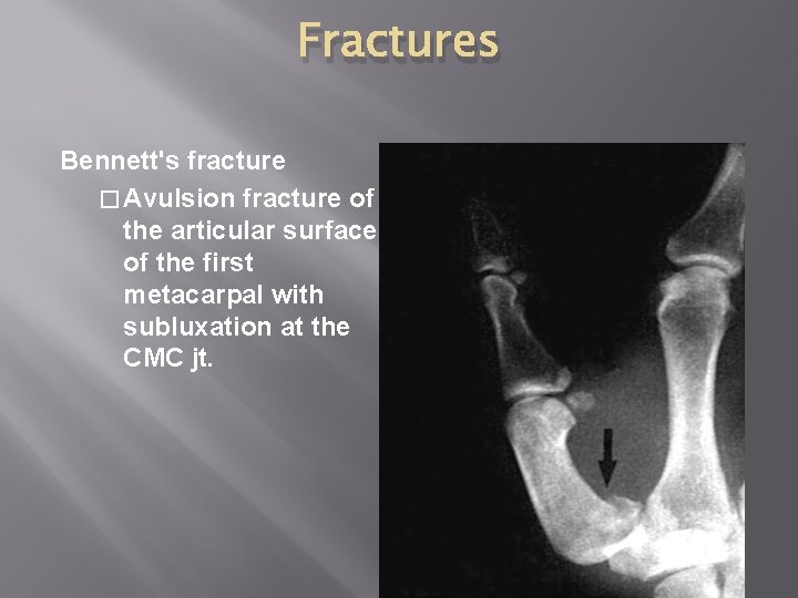 Fractures Bennett's fracture � Avulsion fracture of the articular surface of the first metacarpal