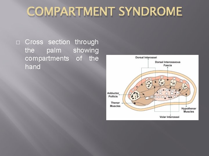 COMPARTMENT SYNDROME � Cross section through the palm showing compartments of the hand 