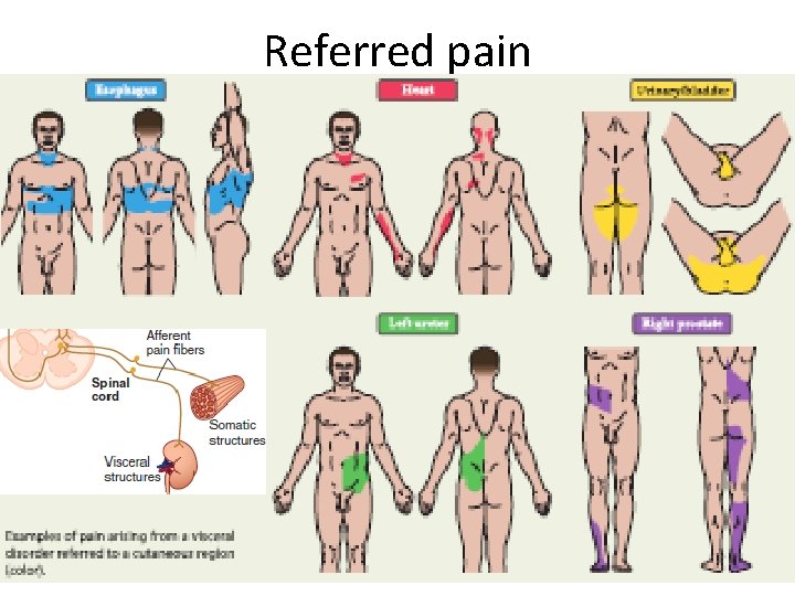 Referred pain 