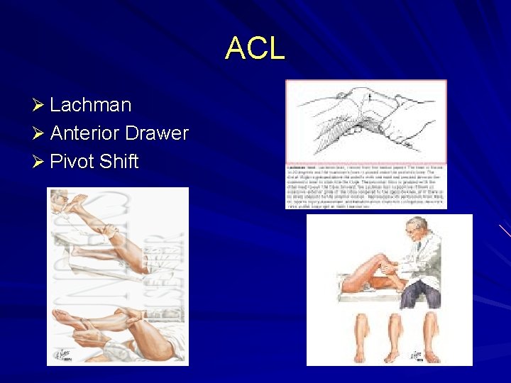 ACL Ø Lachman Ø Anterior Drawer Ø Pivot Shift 